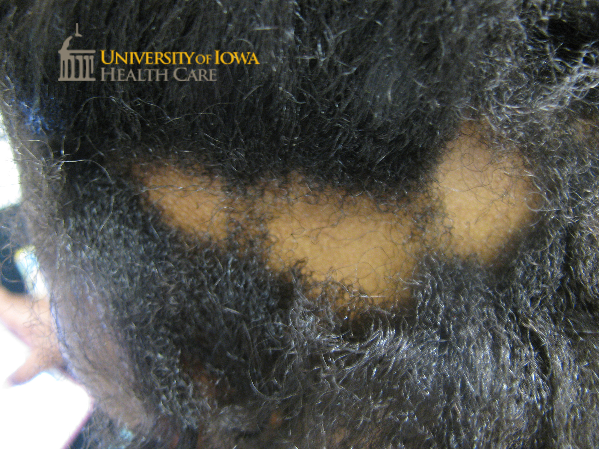 Round patch of nonscarring alopecia on the scalp. (click images for higher resolution).